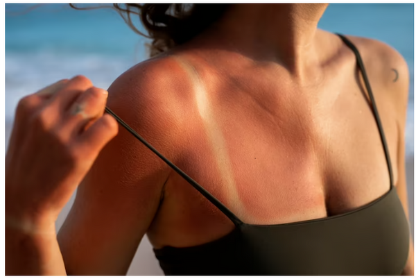 How to Heal Sun Damaged Skin